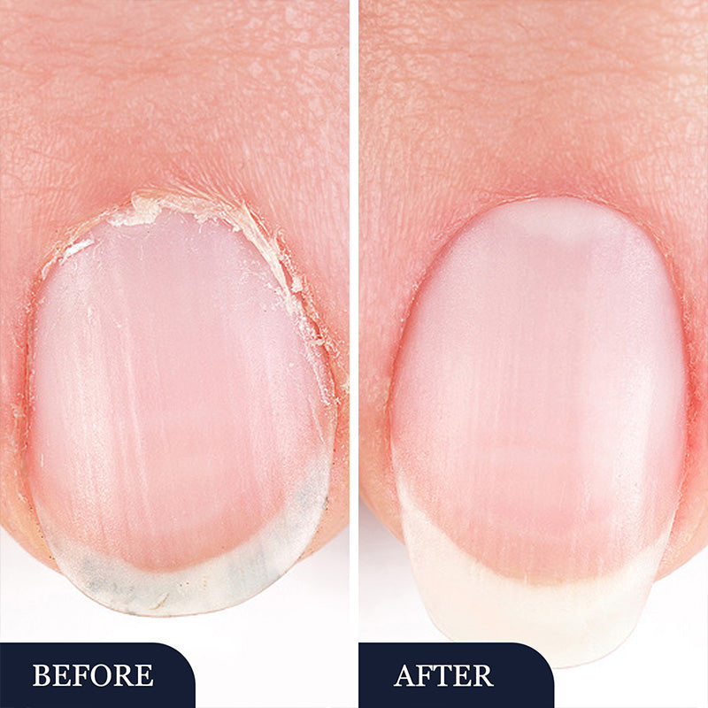😫 Uñas Amarillas? Lápiz Restaurador, ¡90% Menos Decoloración! ⏳🛡️ 80% Menos Roturas+💧 72h Hidratación!